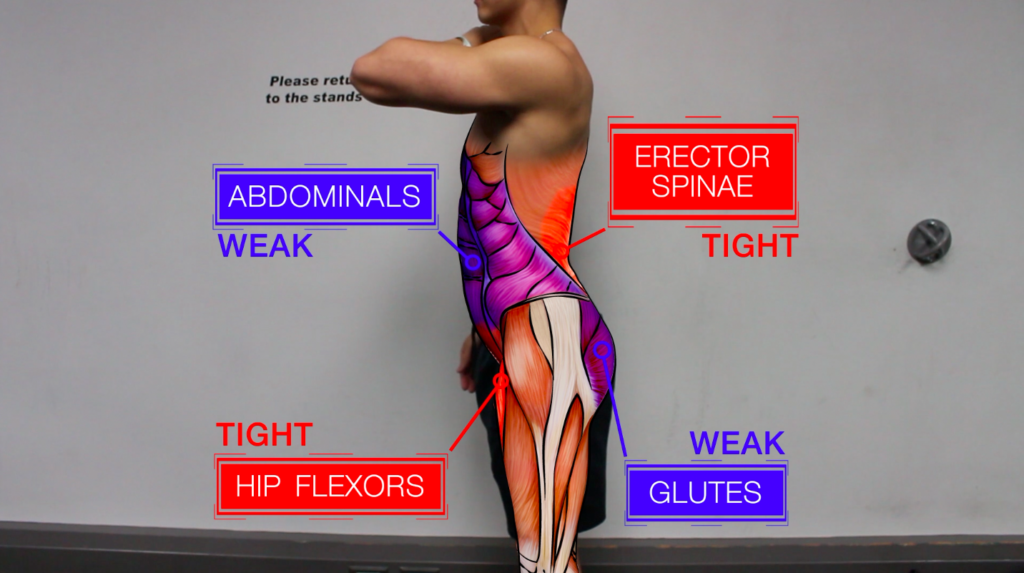 Anterior rotated hip