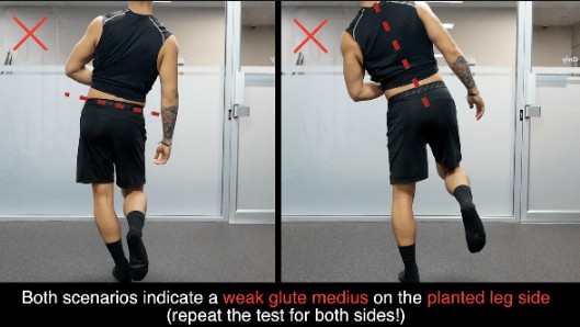 testing for gluteus medius weakness